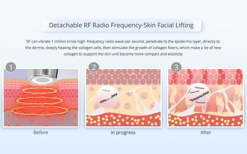 Nguyên lý hoạt động của sóng RF trên da